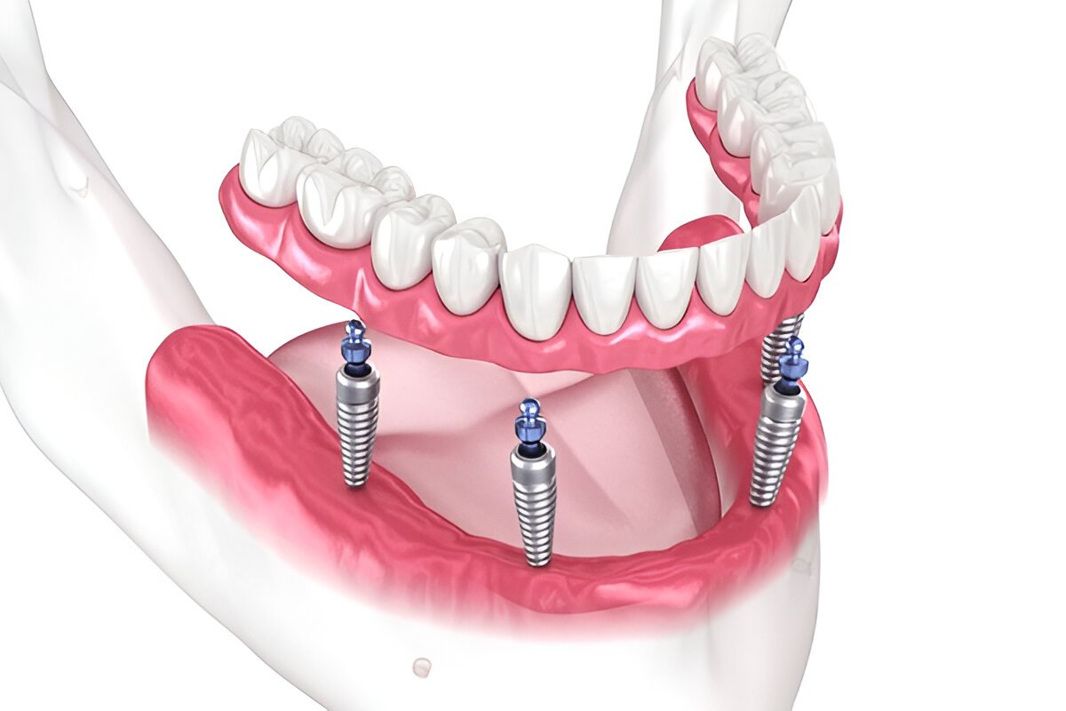 all-on-x implants in downtown edmonton