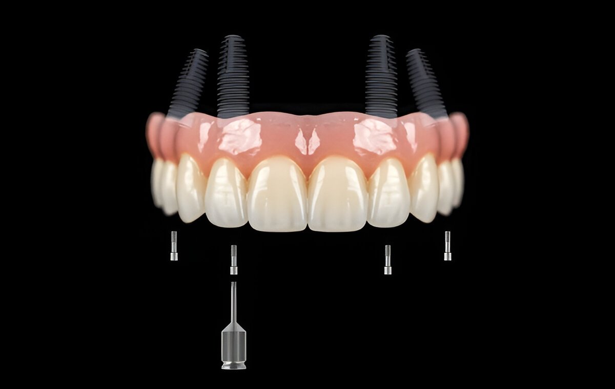 all-on-x implants near you