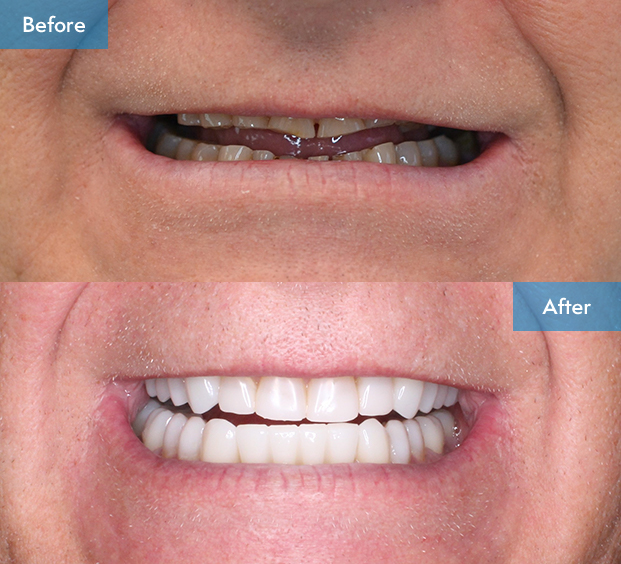 before after 2