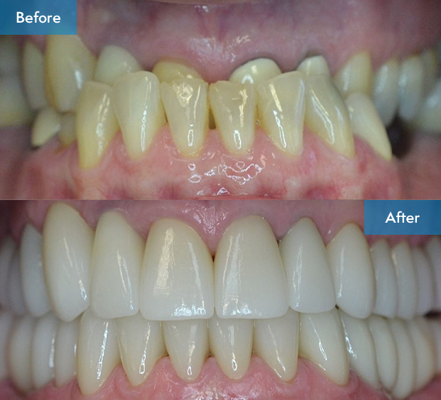 before after 4