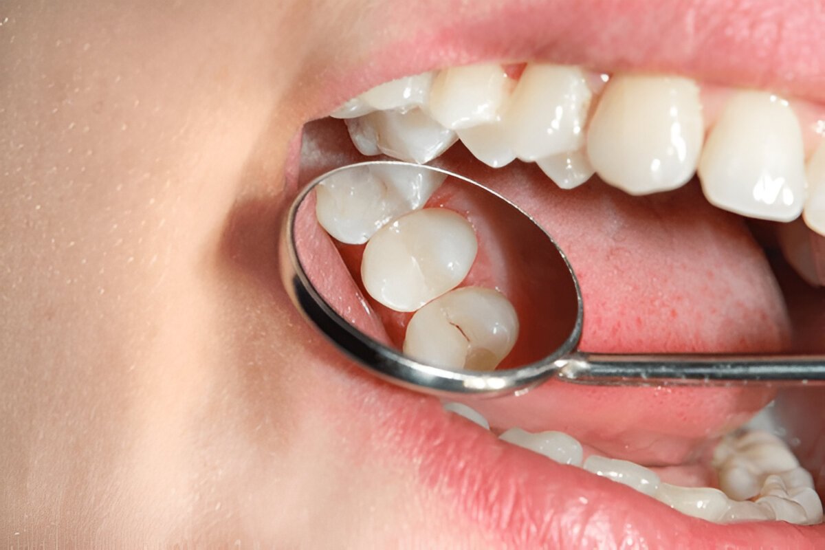 dental fillings in downtown edmonton