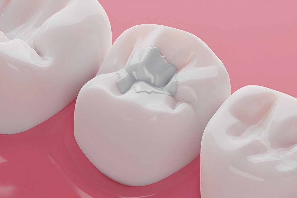 dental fillings near you