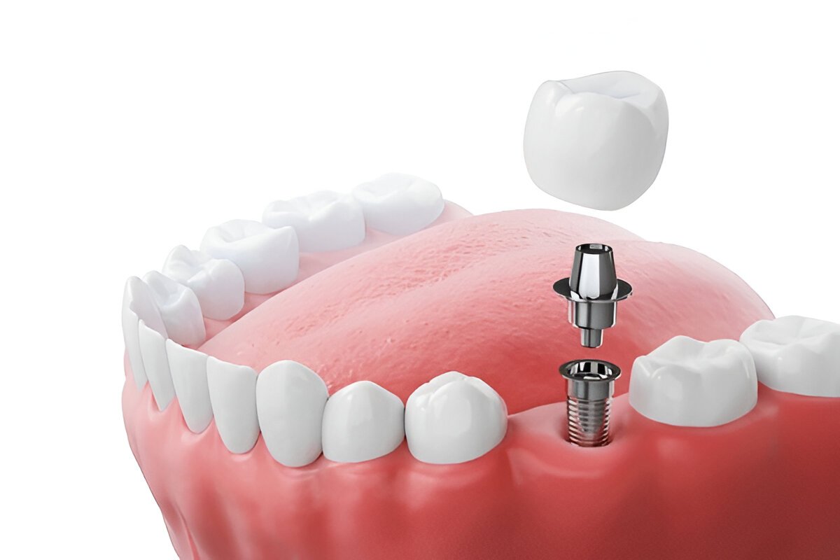 dental implants near you