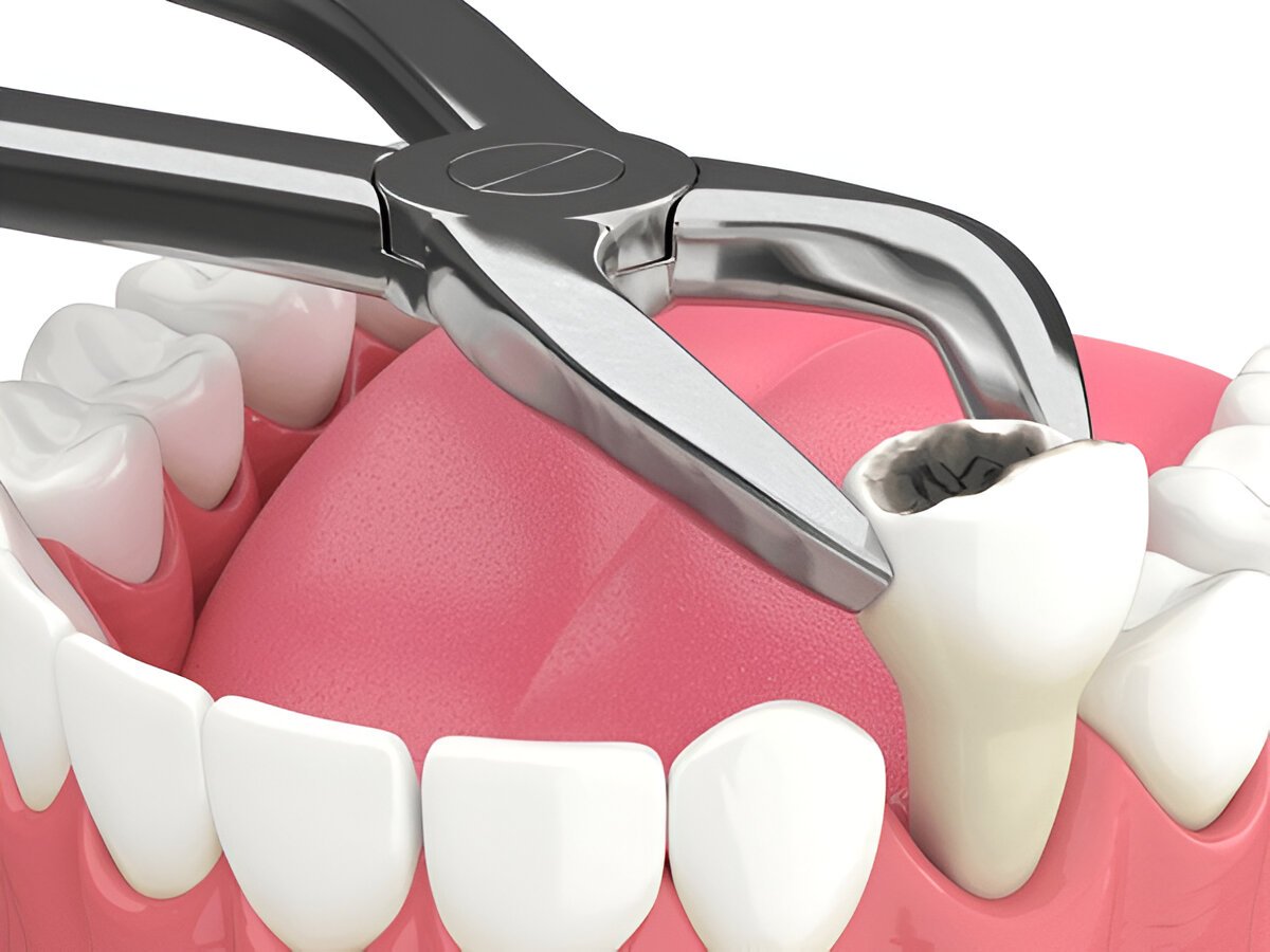 tooth extractions near you