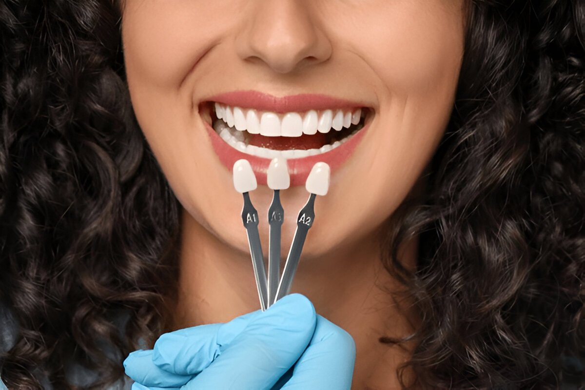 veneers near you