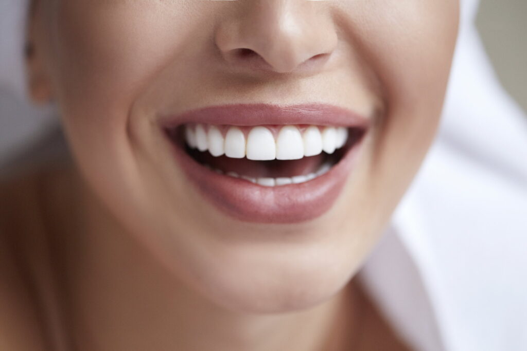 veneers-uncovered