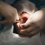 Wisdom teeth keep them or remove them