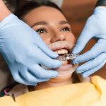 Before and After: Crowded Teeth Fixed by Invisalign